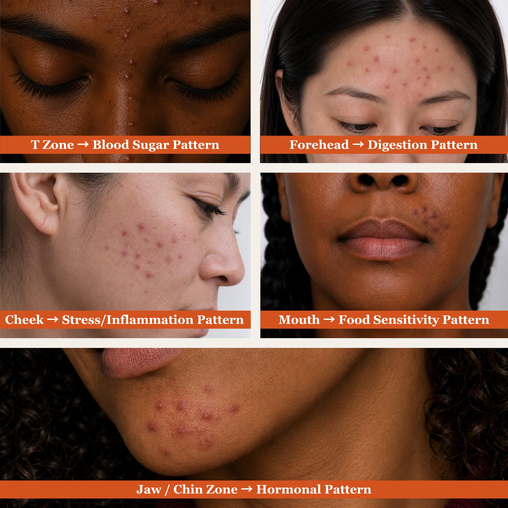 The five acne zones with their internal drivers — Jaw and Chin (Hormonal Pattern), T-Zone (Blood Sugar Patter), Cheek (Stress and Inflammation Pattern), Forehead (Digestion Pattern), Mouth (Food Sensitivity Pattern). A face mapping reference for adult wome